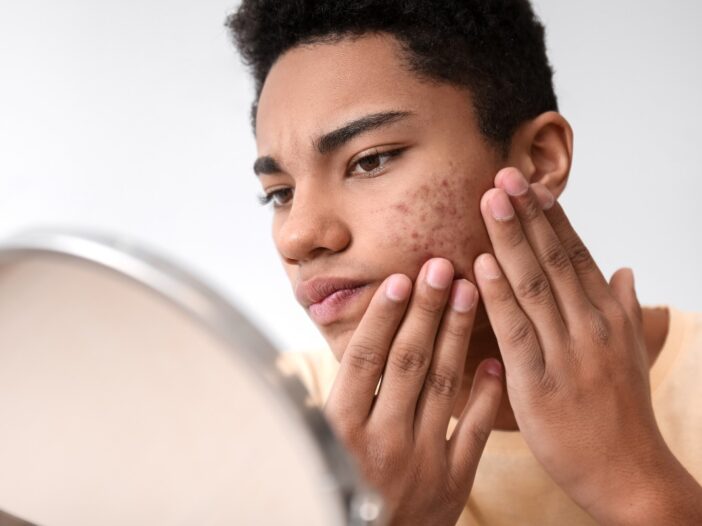 Jongen met acne op zijn wang kijkt onzeker in de spiegel.